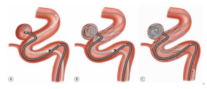 蛇牌动脉瘤夹列表图图片